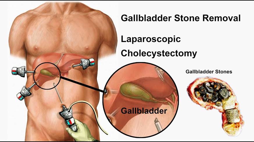 Gall Bladder Stone Removal