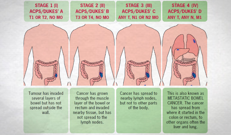 Bowel Cancer Staging