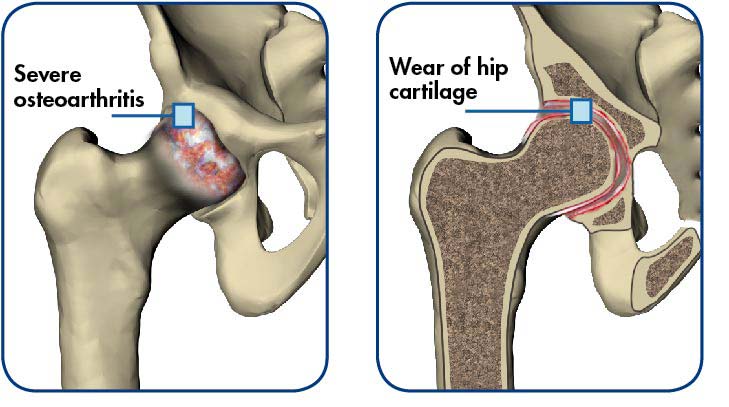 Hip Replacement Surgery