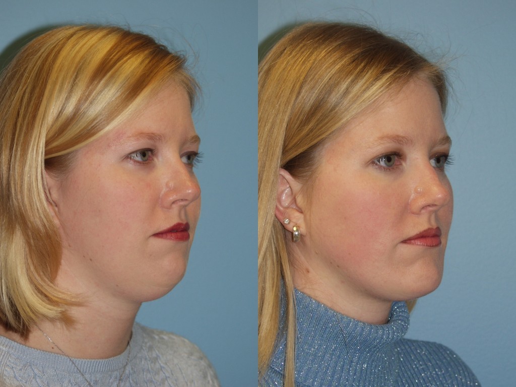 Chin Augmentation Before and After