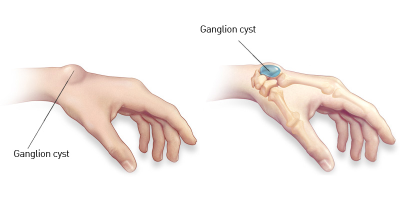 Ganglion Cyst Removal