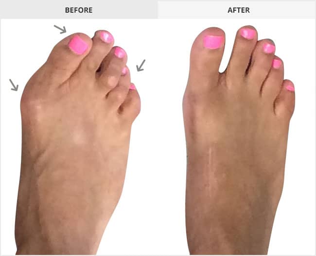 Before and After Bunion Surgery