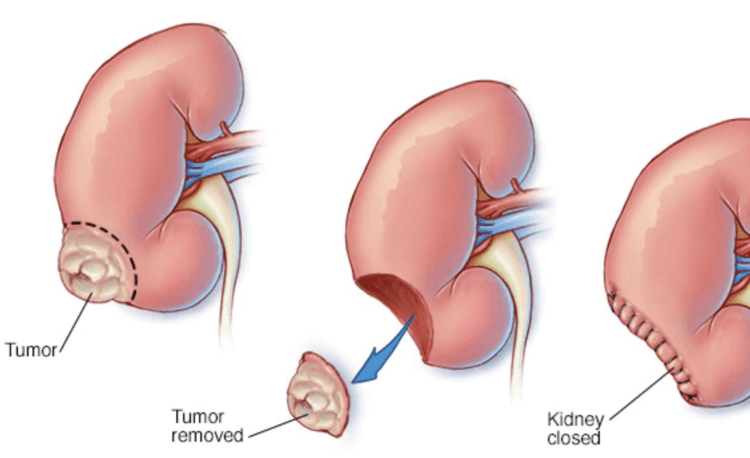 Nephrectomy Procedure