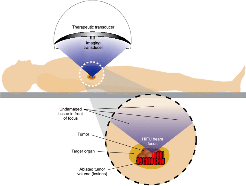 HIFU treatment of a pancreatic tumor