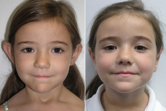 Otoplasty Before and After