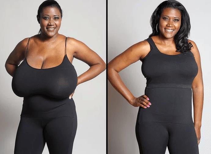 Before and After Breast Reduction