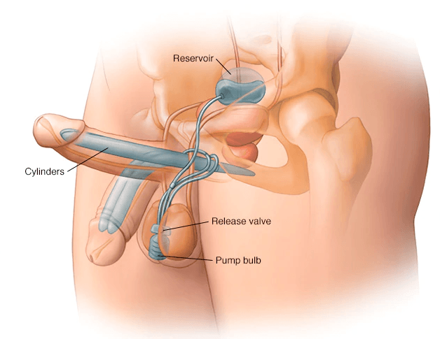 Penile Implant: Flaccid and Erect