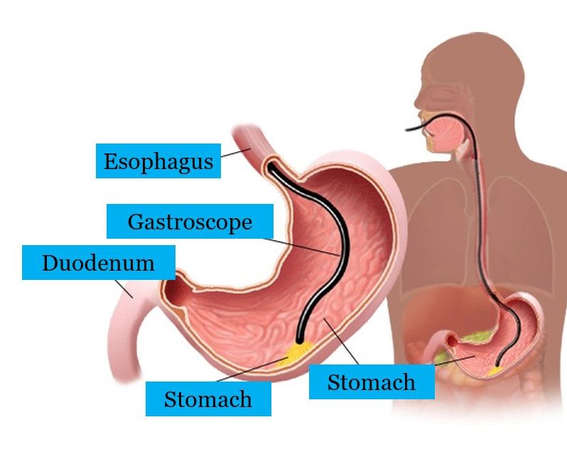 Gastroscopy