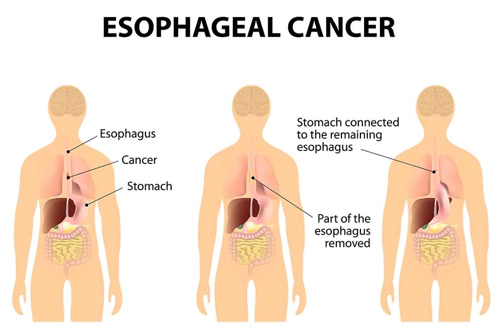 Esophageal Cancer Surgery