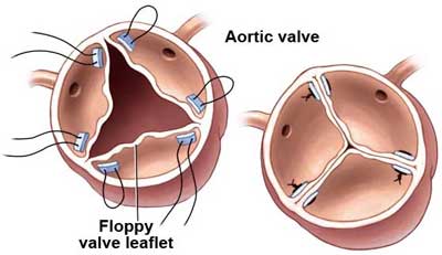 Aortic Valve Repair