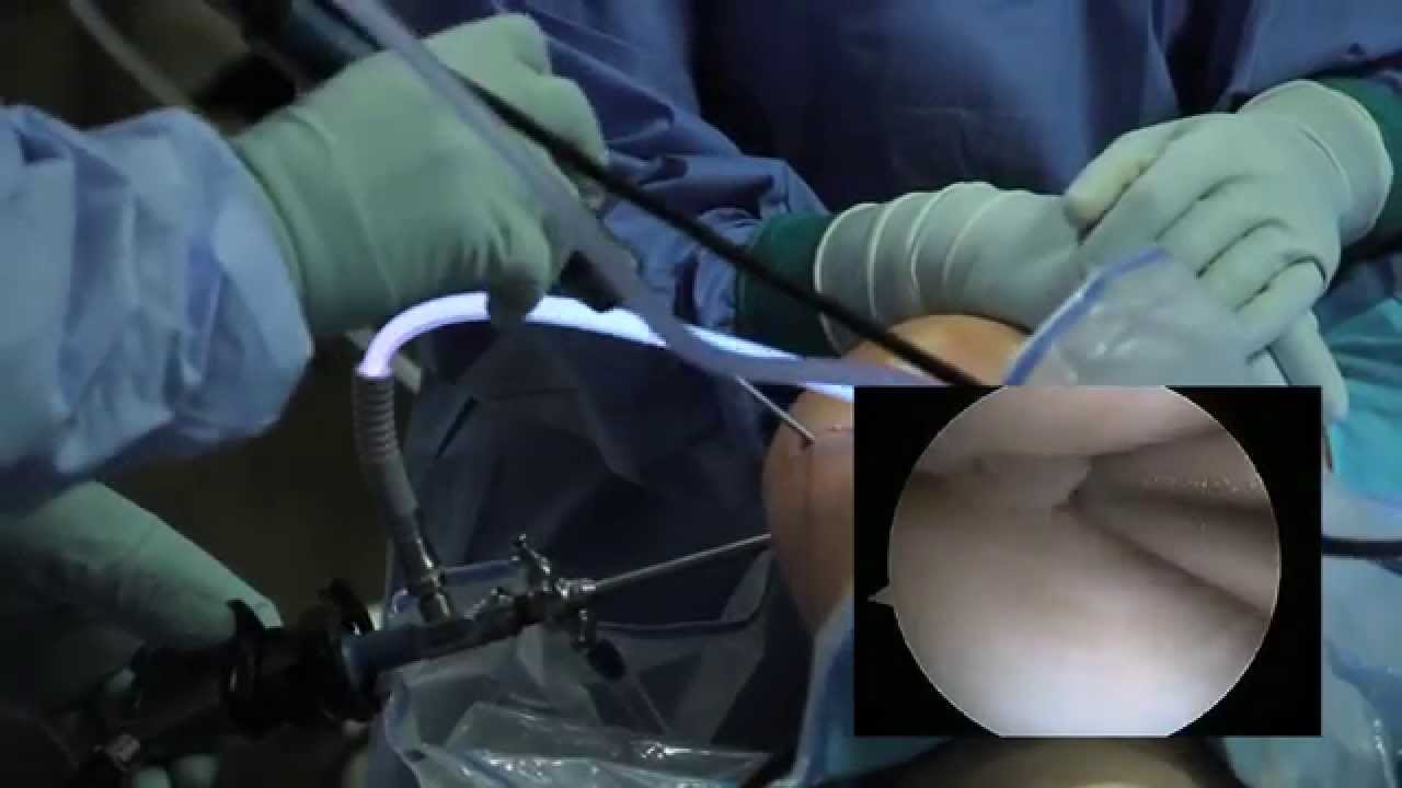 Knee Arthroscopy