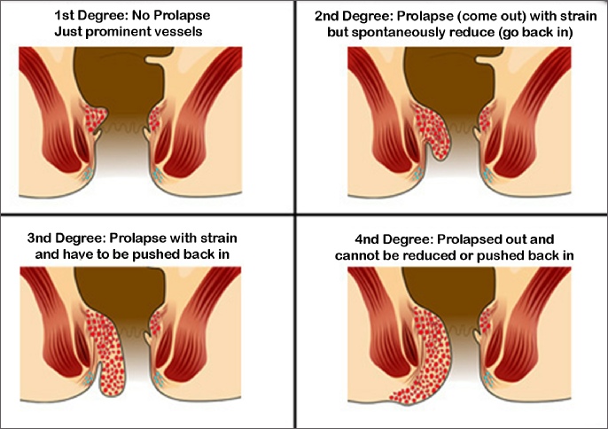 Hemorrhoidectomy 