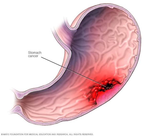 Stomach Cancer