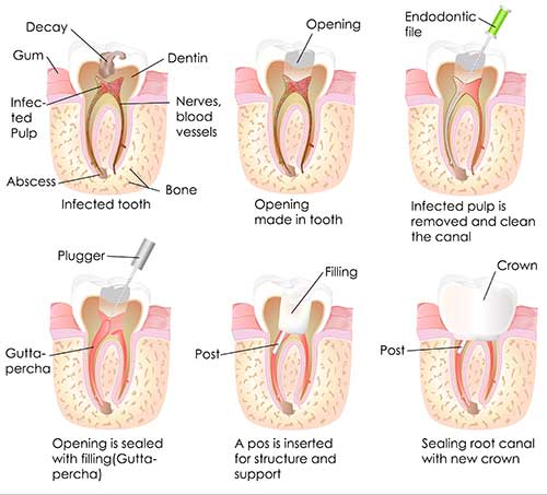 Root Canal Procedure