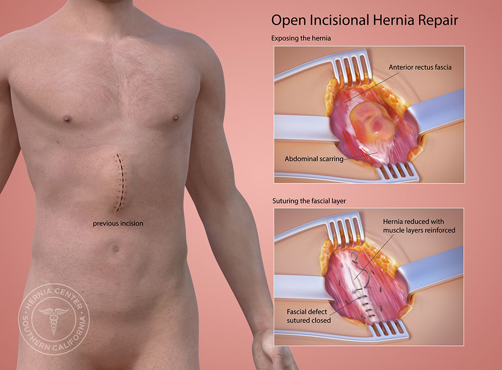 Open Incisional Hernia Repair