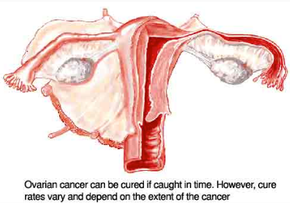 Ovarian Cancer