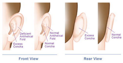 Otoplasty Front view and Rear view