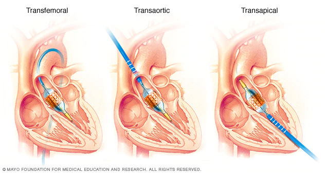 Transcatheter Aortic Valve Replacement