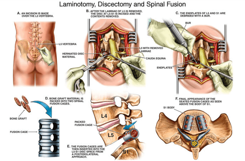 Types of Spine Surgery