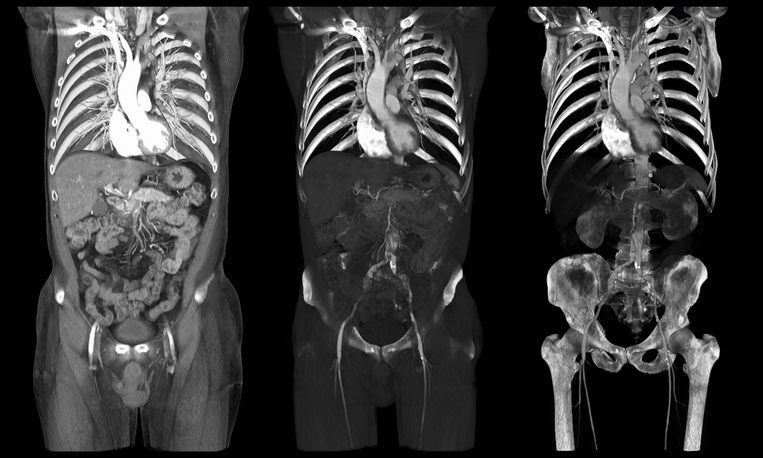 Pelvis or Pelvic CT Scans