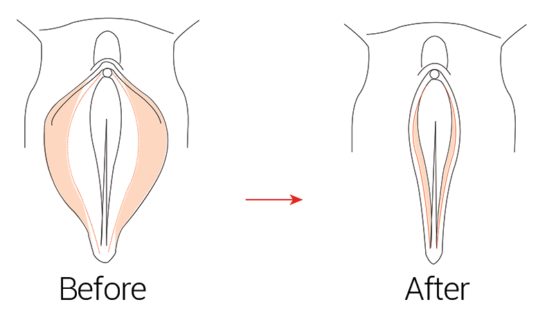 Vagionplasty Procedure