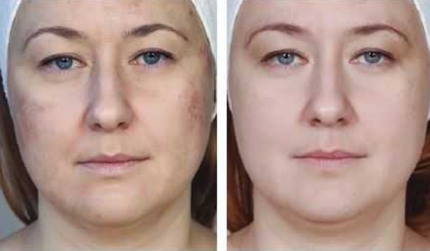 Mesotherapy Before and After