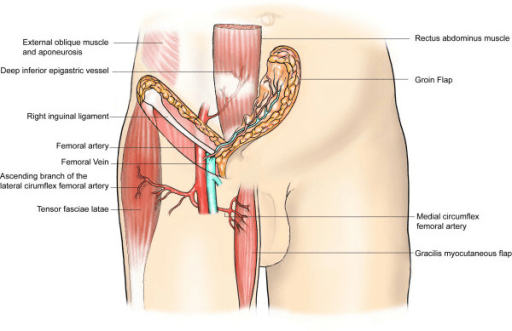 Simple Orchiectomy