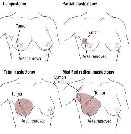 Types of Surgery