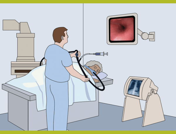 ERCP Procedure