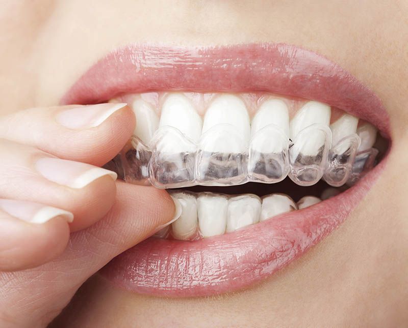 Clear Aligners