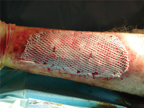 Skin Graft Treatment