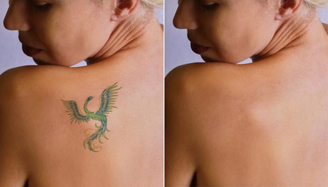 Tattoo removal Before and After