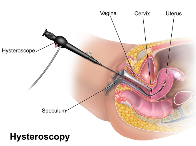 Hysteroscopy