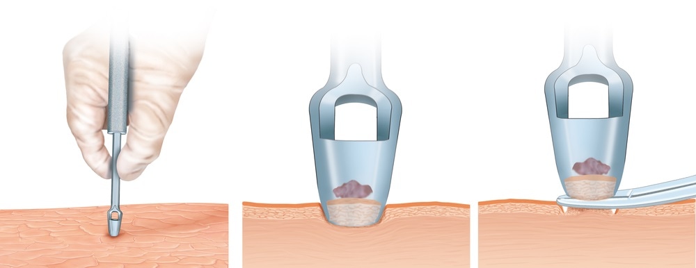 Punch Biopsy