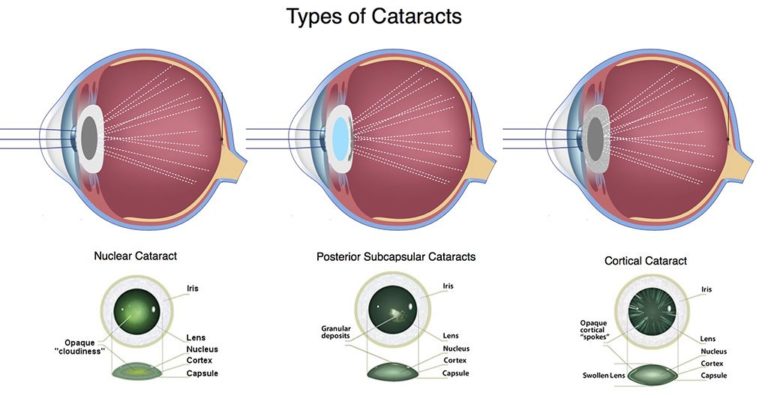 Types of Cataracts