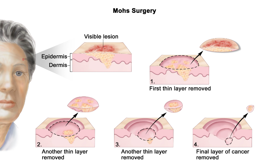 Mohs Surgery