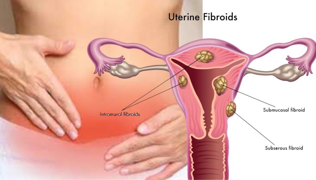 Uterine Fibroids