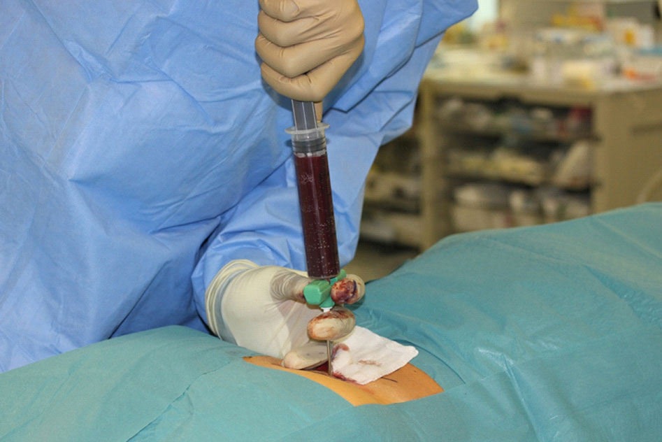 Bone Marrow Aspiration