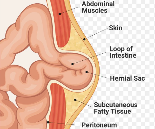 Umbilical Hernia