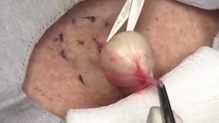 Epidermoid Cyst