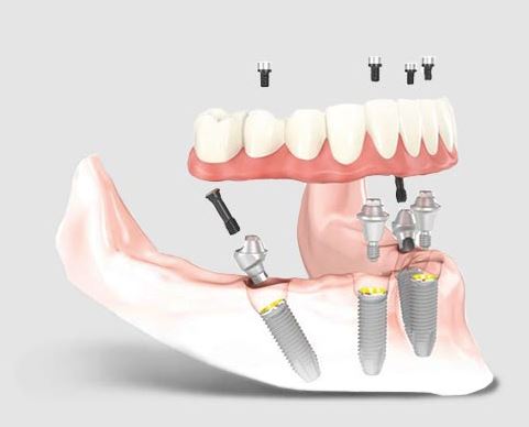 All-On-4 Procedure