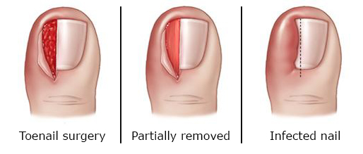 Ingrown Toenail Treatment Options