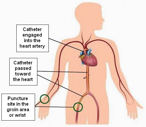 What is a Coronary Angiogram