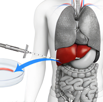 Liver Biopsy