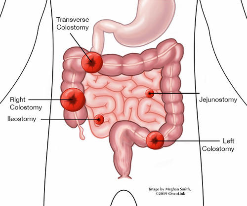 Colostomy Surgical Procedure