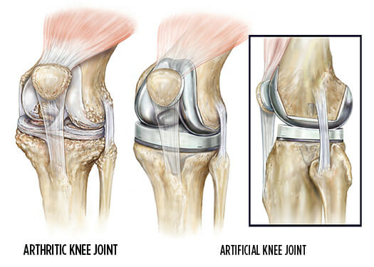 Total Knee Replacement