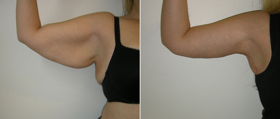 Arm Lift Before and After