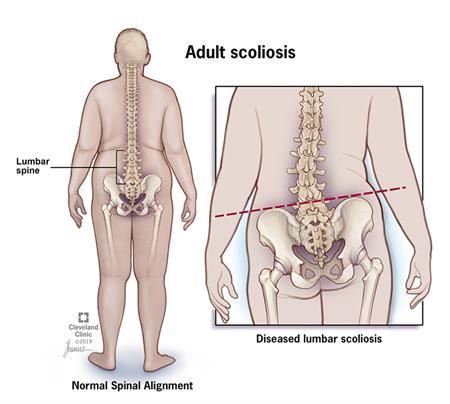 Adult Scoliosis