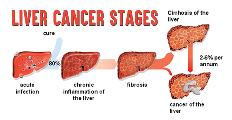 Liver Cancer Stages