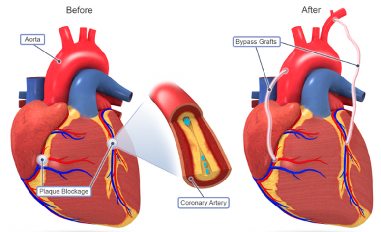 CABG Surgery